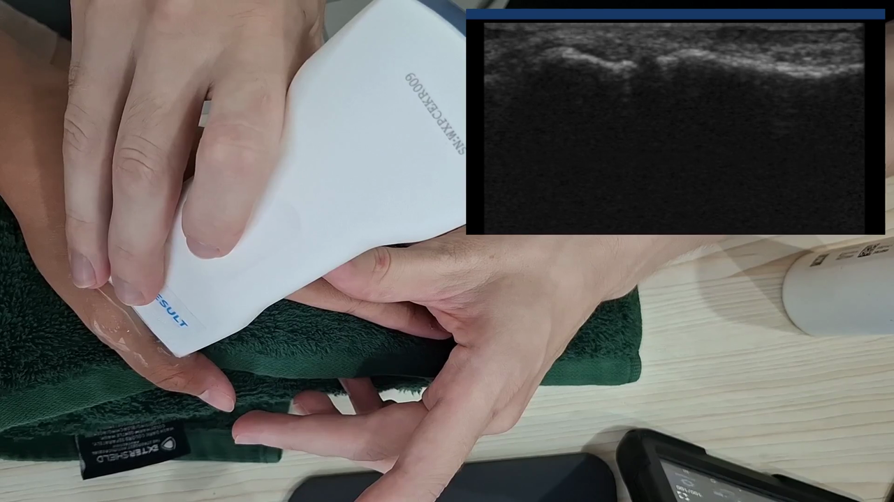 Thumb ulnar collateral ligament · B-mode · D3Ultra · Linear probe scan preview