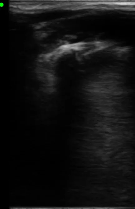 Joint bone surface