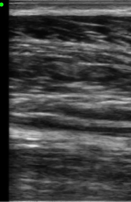 Layered superficial soft tissue