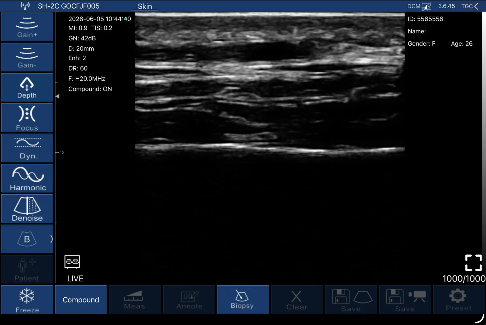 Longitudinale B-mode van epidermis tot hypodermis bij 20 MHz