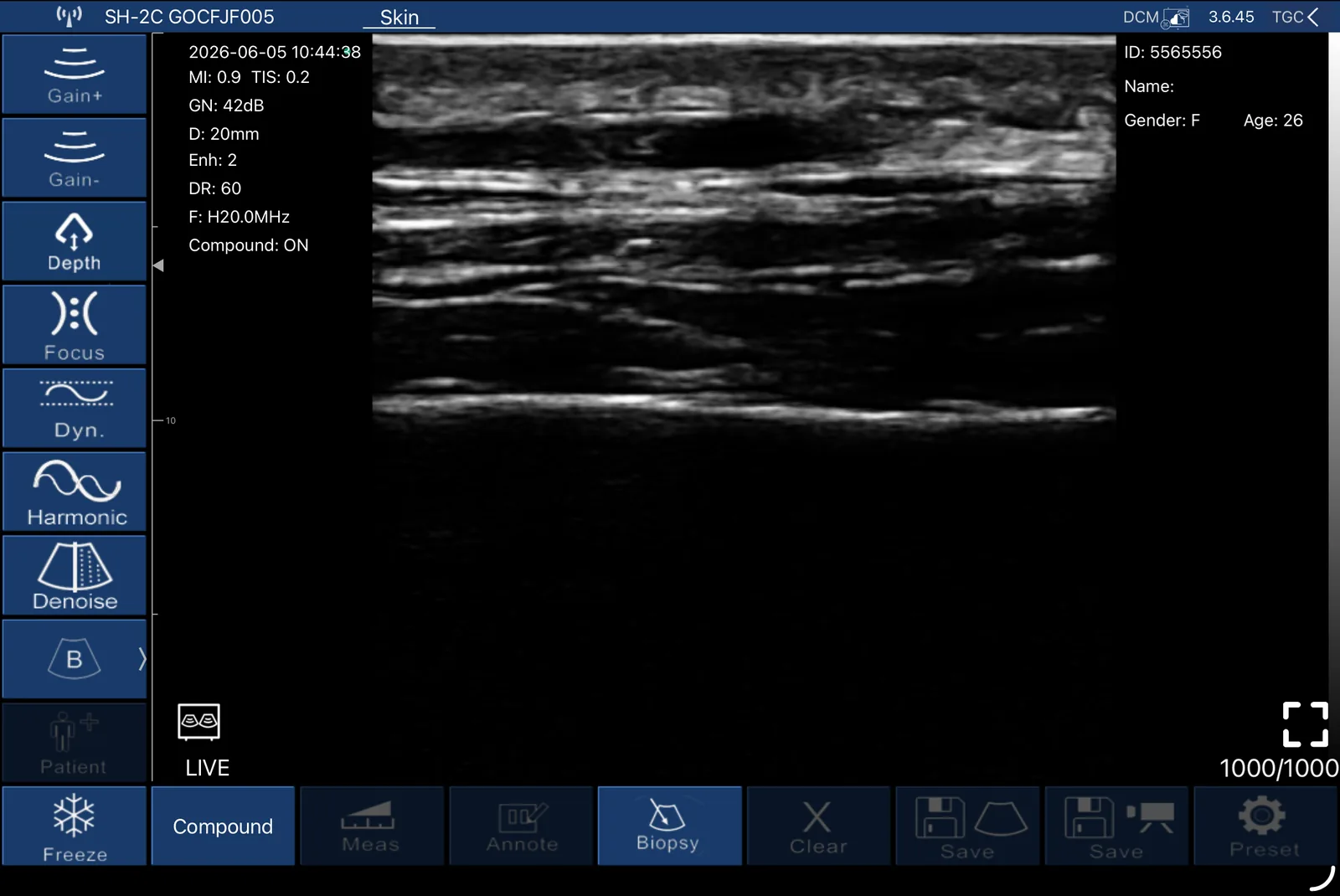 Longitudinale cutane en subcutane scan bij 20 MHz