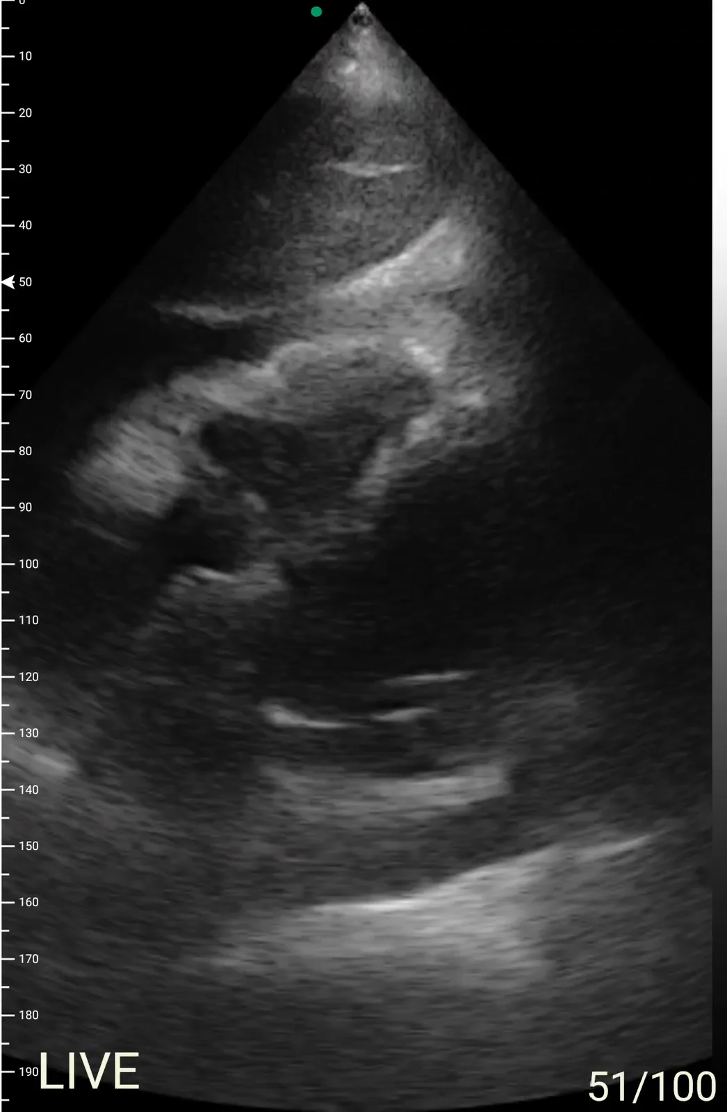 Pericardiale ruimte · B-mode · Phased array scanvoorbeeld
