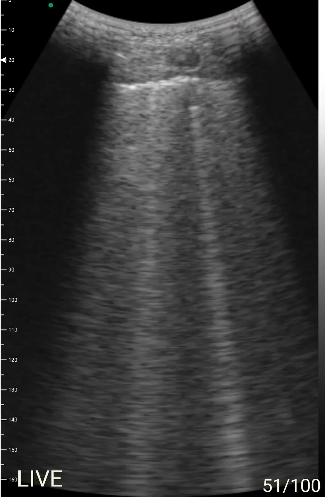 Long-B-lijnen · B-mode · convexe probe scanvoorbeeld