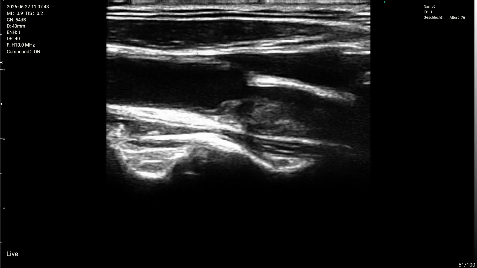 Naaldbenadering hals · B-mode · 10 MHz-scanvoorvertoning