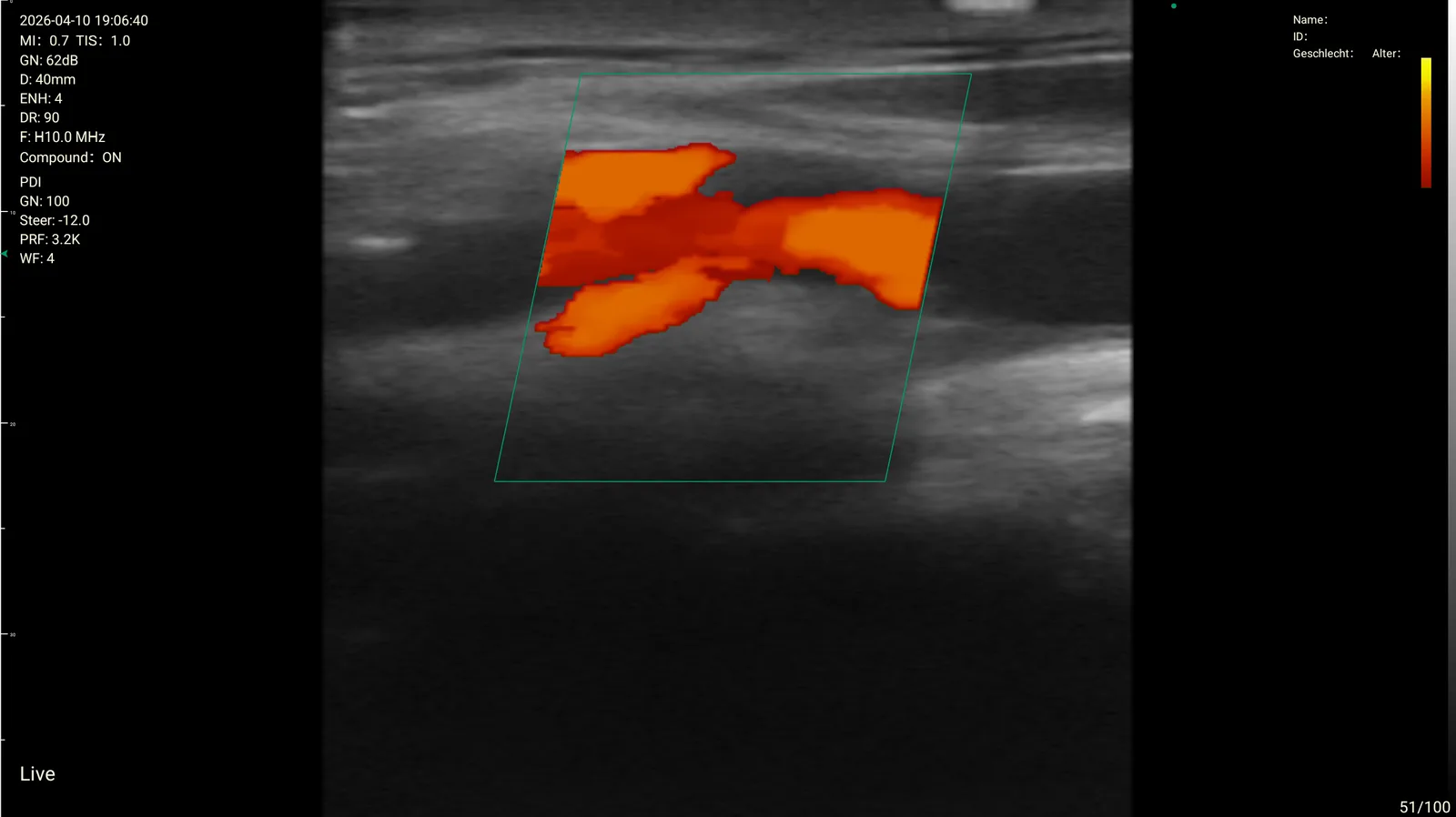 Longitudinaal vat · powerdoppler · 10 MHz scanvoorbeeld