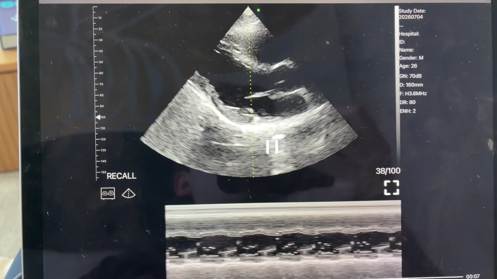 Cardiale lange-asopname · B-mode + M-mode · 3.6 MHz-scanvoorbeeld