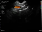 Endocavity ultrasound image from the Suresult D2LT