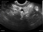 Endocavity ultrasound image from the Suresult D2LT