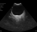 Ocular ultrasound image from the Suresult E11 micro-convex probe