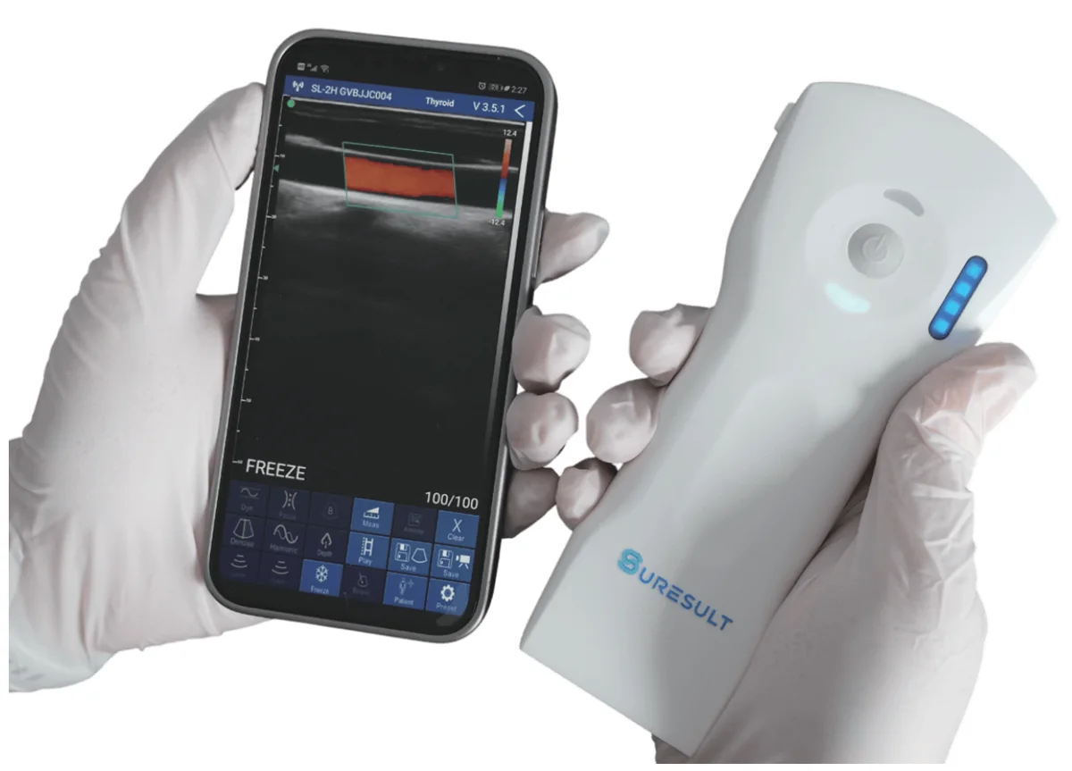 Draadloze Suresult handheld echografie-probe naast een smartphone waarop de Suresult-app in kleurendopplermodus draait