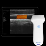 Suresult L10SH linear probe with tablet showing a colour Doppler scan