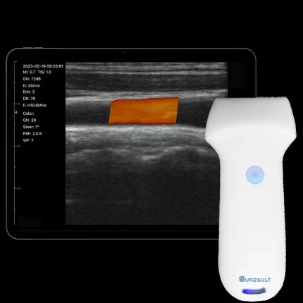 Suresult L10SH linear probe with tablet showing a colour Doppler scan