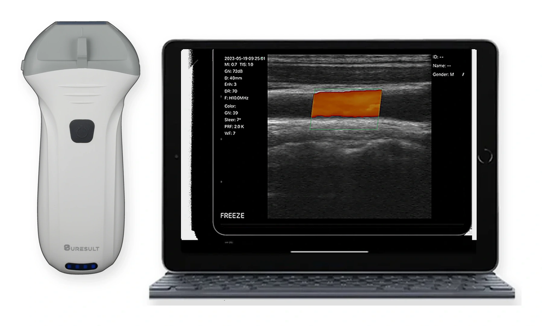 Suresult L14Pro portable ultrasound probe