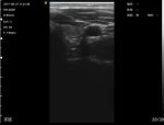 B-mode image from the Suresult L7.5 linear probe