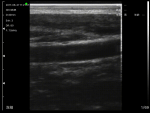 Vascular B-mode image from the Suresult L7.5 linear probe