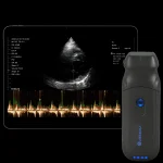 Suresult PD2 phased-array probe with tablet showing a CW Doppler cardiac trace