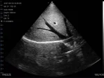 Abdominal ultrasound image from the Suresult PD2 phased-array probe