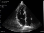 Cardiac B-mode image from the Suresult PD2 phased-array probe