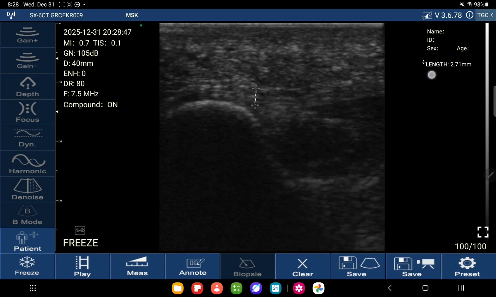Plantaire fascie · B-mode · D3Ultra · 7.5 MHz scanvoorbeeld