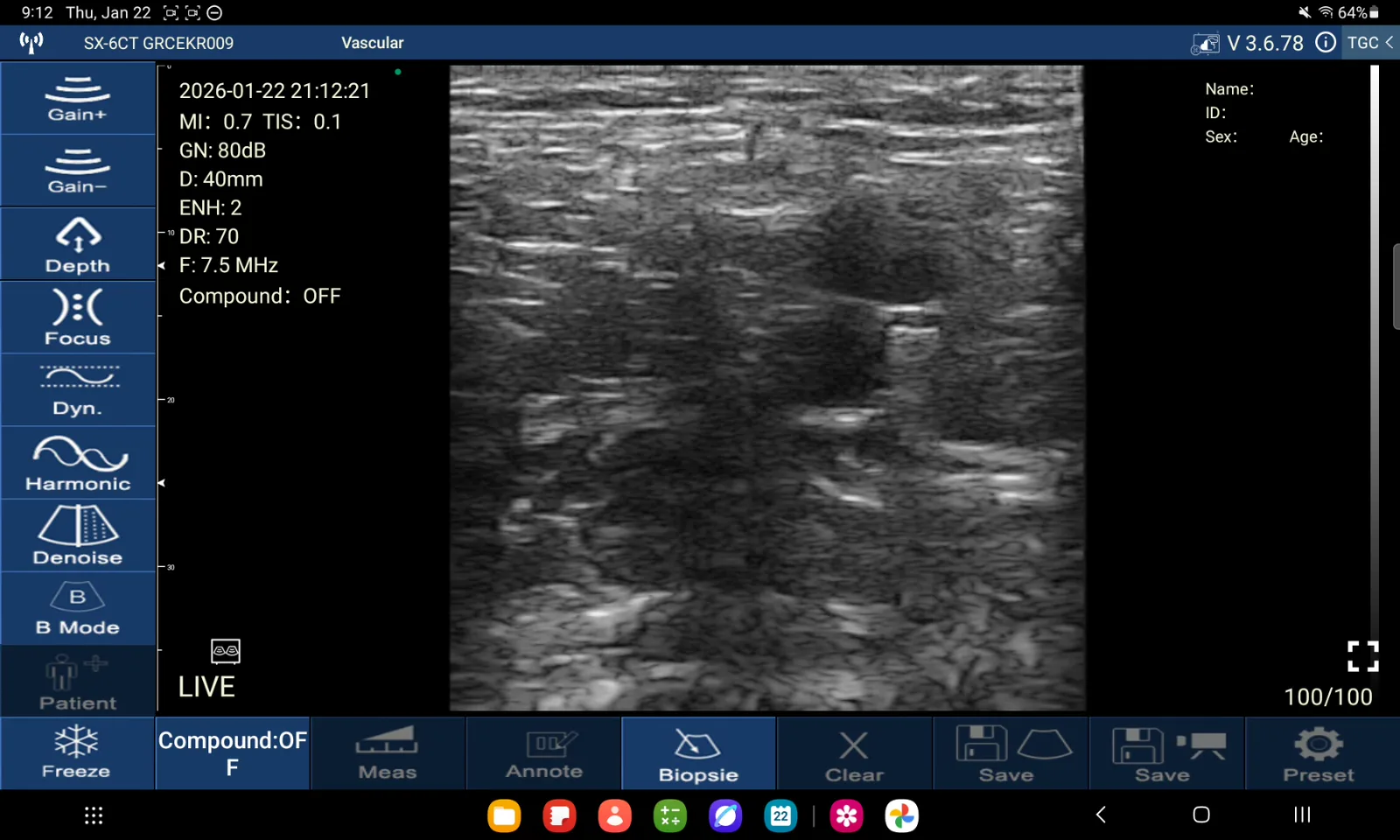 Compressie popliteale vaten · B-mode · D3Ultra · 7.5 MHz scanvoorbeeld