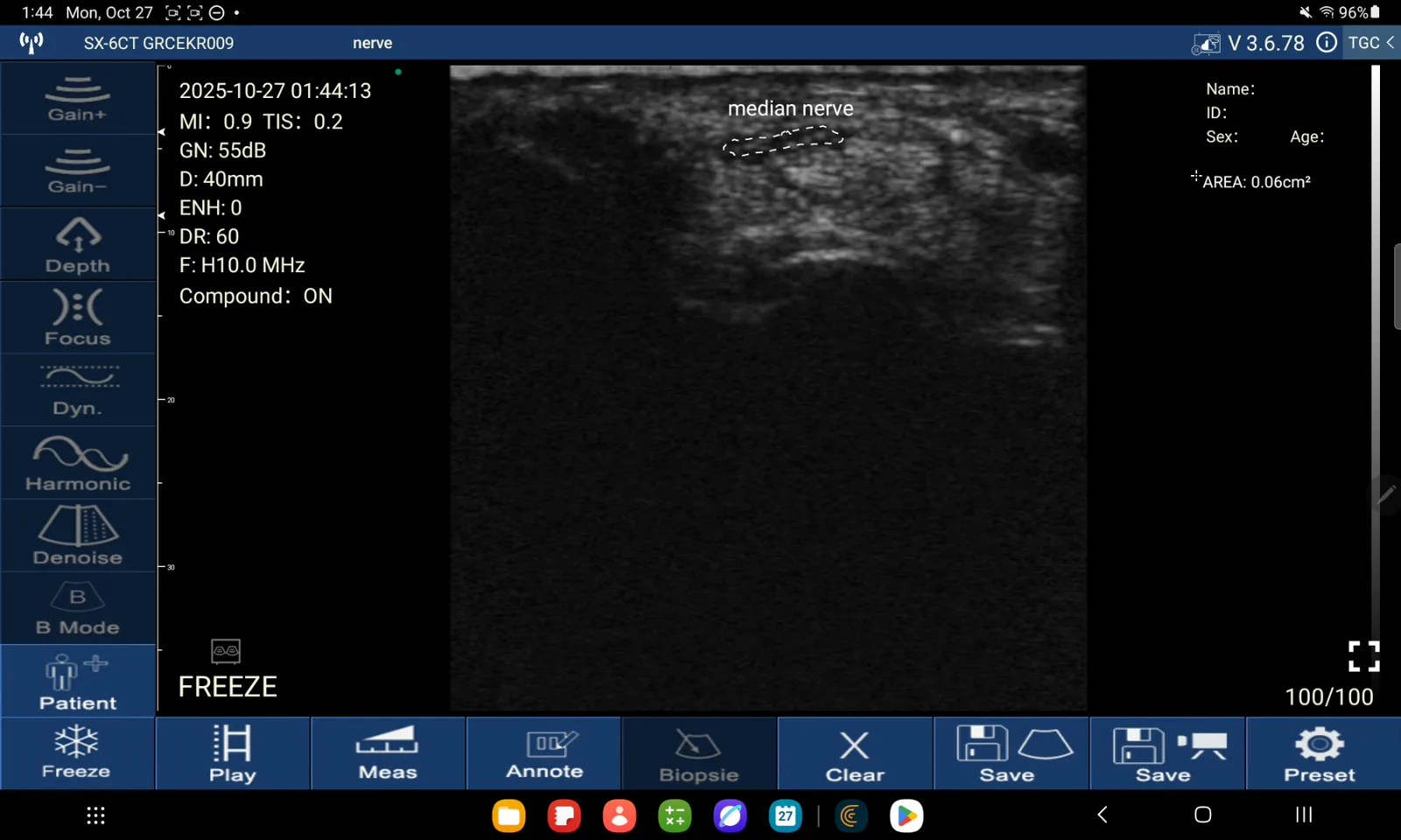 Nervus medianus · B-mode · D3Ultra · 10 MHz scanvoorbeeld