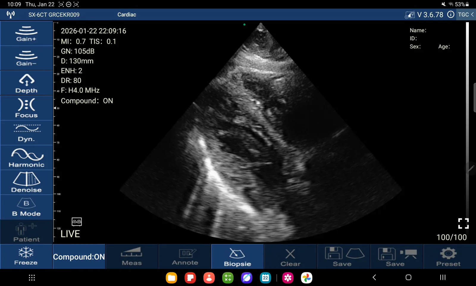 Subxyfoïdale cardiale opname · B-mode · D3Ultra · 4 MHz scanvoorbeeld