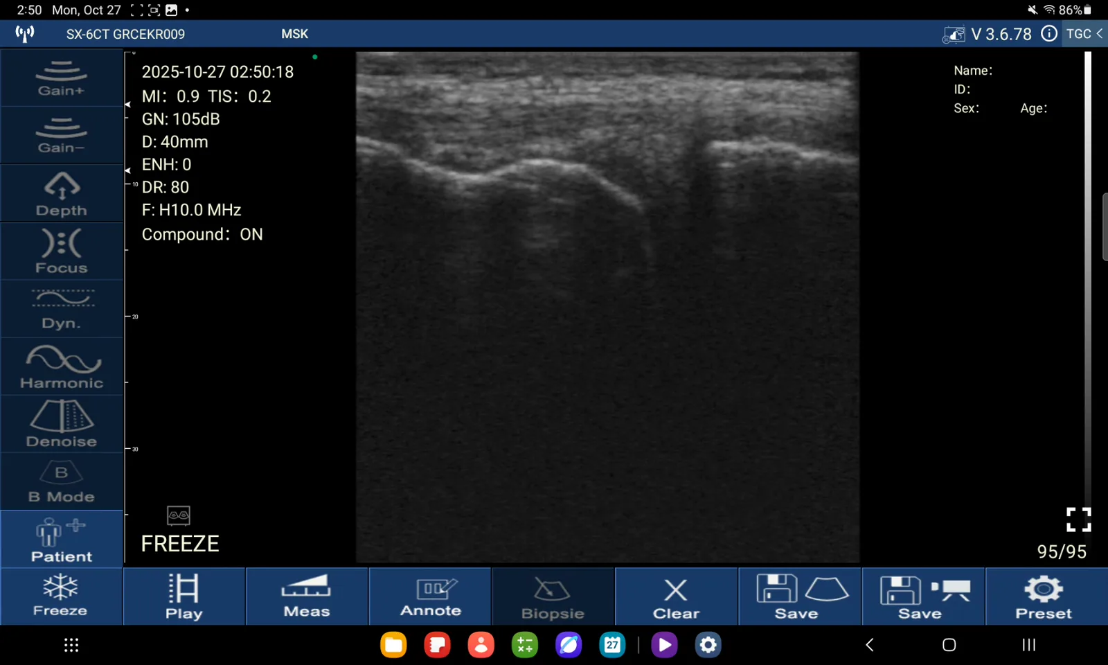 Mediaal collateraal ligament · B-mode · D3Ultra · 10 MHz scanvoorbeeld