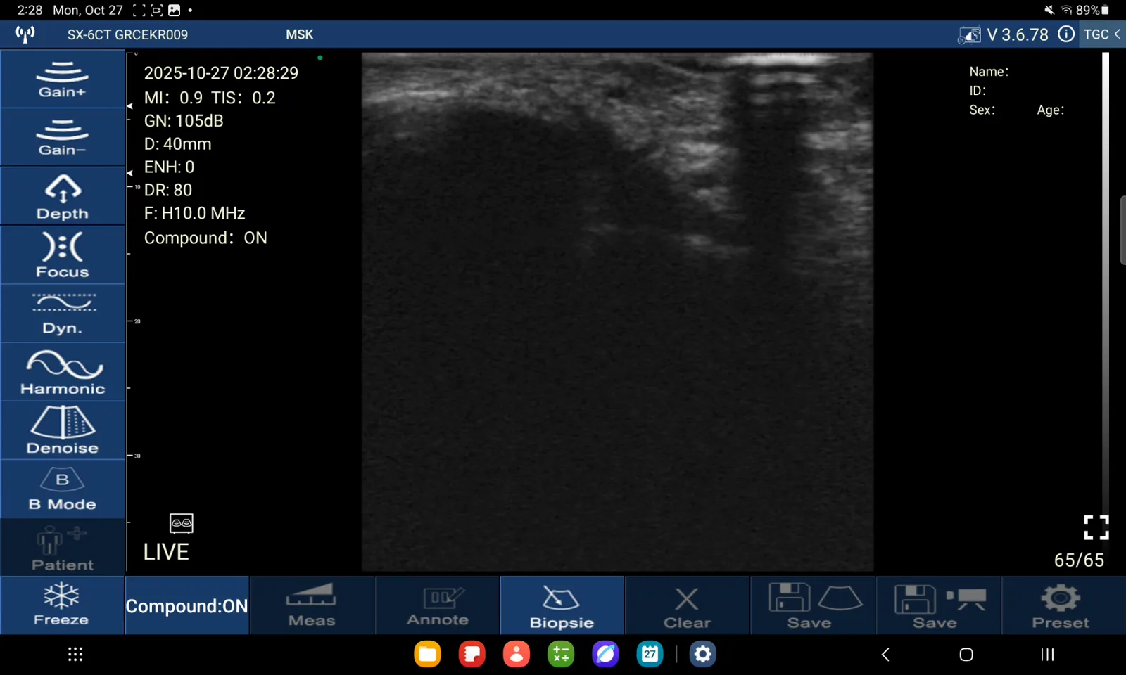 Ligamentum talofibulare anterius · B-mode · D3Ultra · 10 MHz scanvoorbeeld
