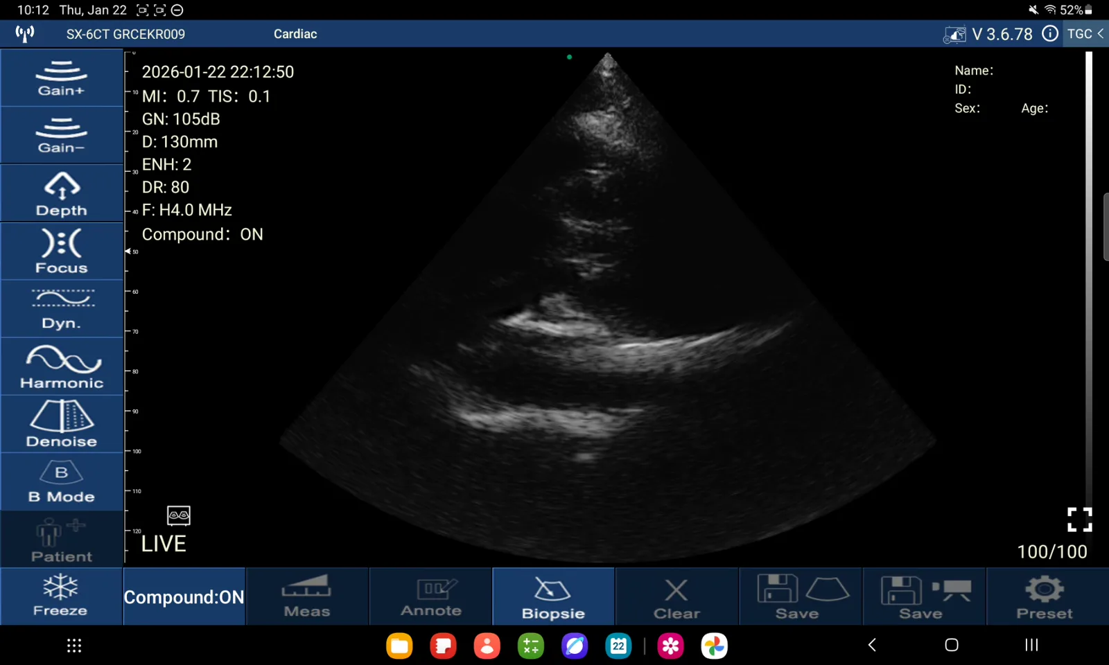 Cardiale lange-asopname · B-mode · D3Ultra · 4 MHz-scanvoorbeeld