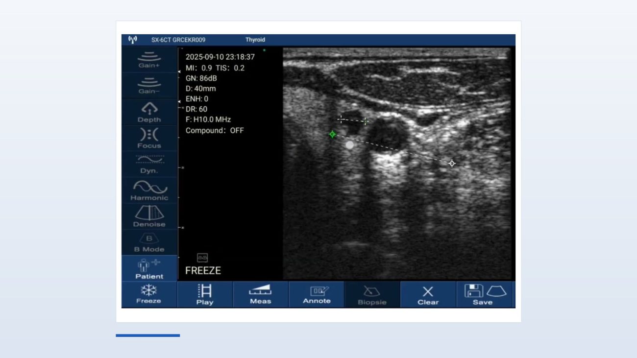 Suresult D3Ultra software window on the Thyroid preset: electronic calipers placed across a small anechoic thyroid nodule in the transverse plane, 40 mm depth, H10.0 MHz, compound imaging off