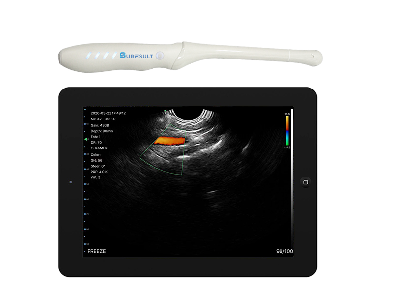 Suresult T8 endocavity transvaginal handheld ultrasound probe with tablet display