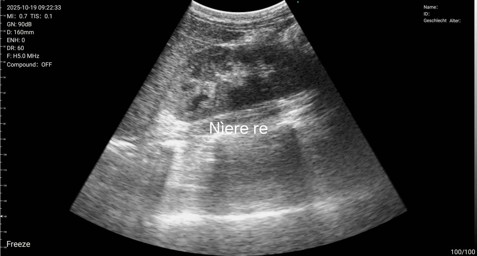Urology: urology 02 right kidney long axis d3ultra