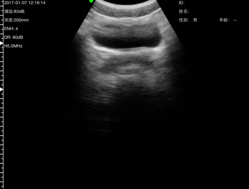 Bladder cine loop from the reference library