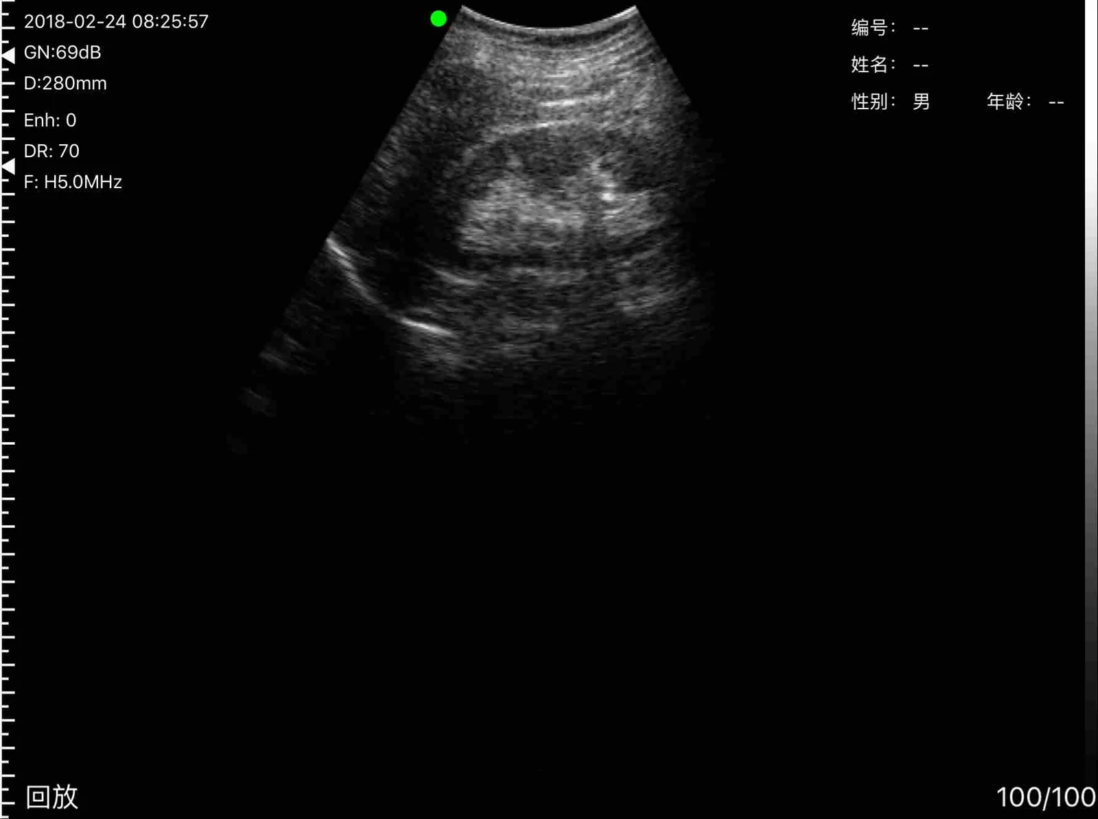 Bright focus in the renal sinus