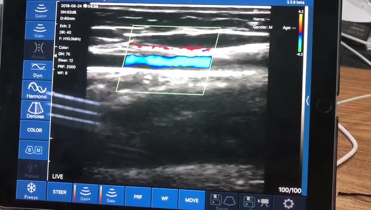 Colour Doppler confirming a vessel before the needle pass