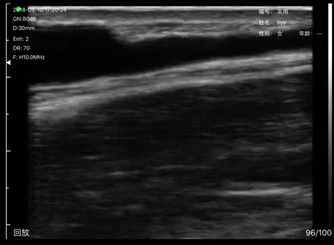 Forearm superficial vein ultrasound