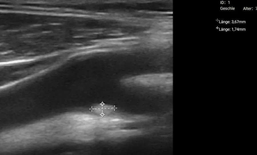 Frozen vessel image with two caliper measurements on a Suresult handheld ultrasound