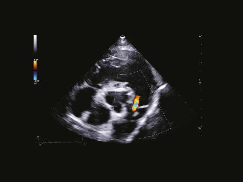 Pulmonalisklepregurgitatie bij de hond in kleurendoppler op Esaote MyLab Omega eXP VET, van Esaote