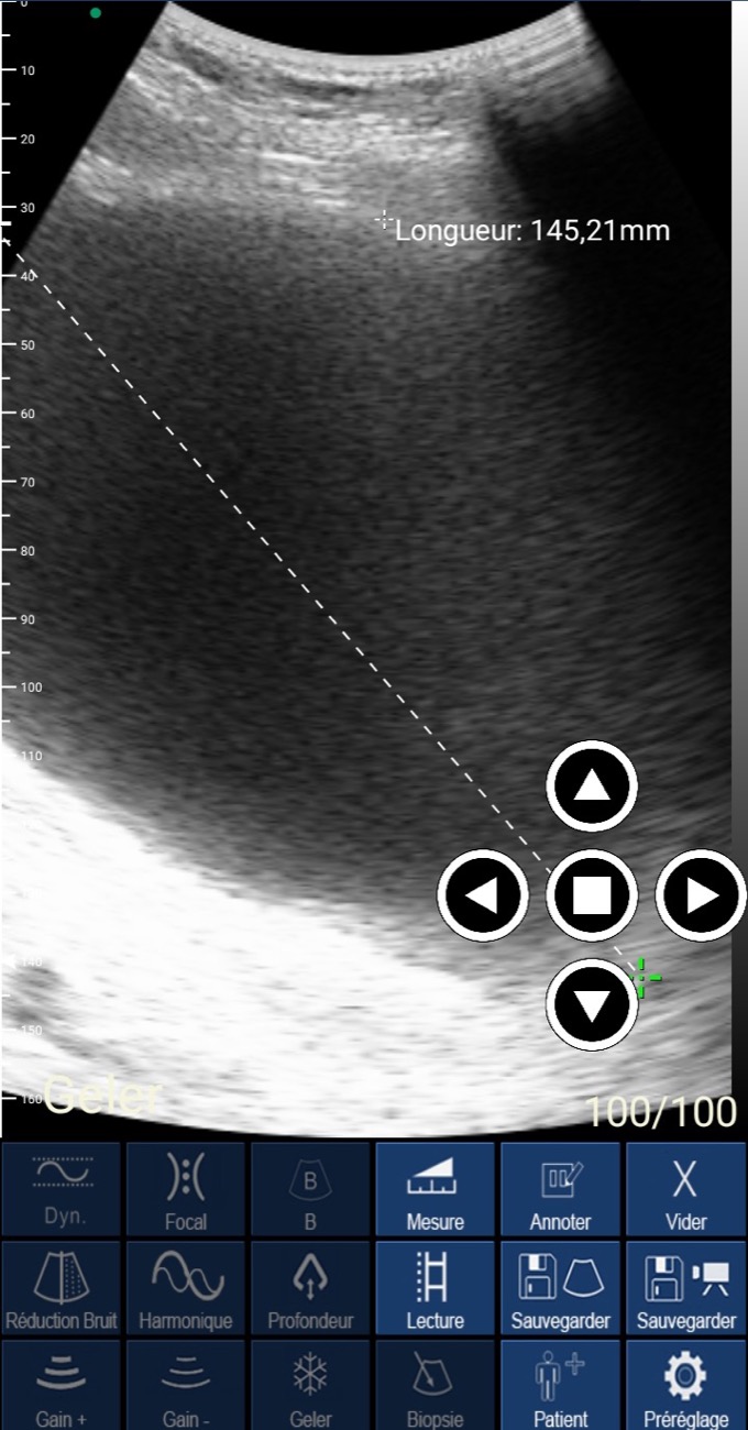 Wireless ultrasound app during a live scan with an on-screen 145 mm measurement
