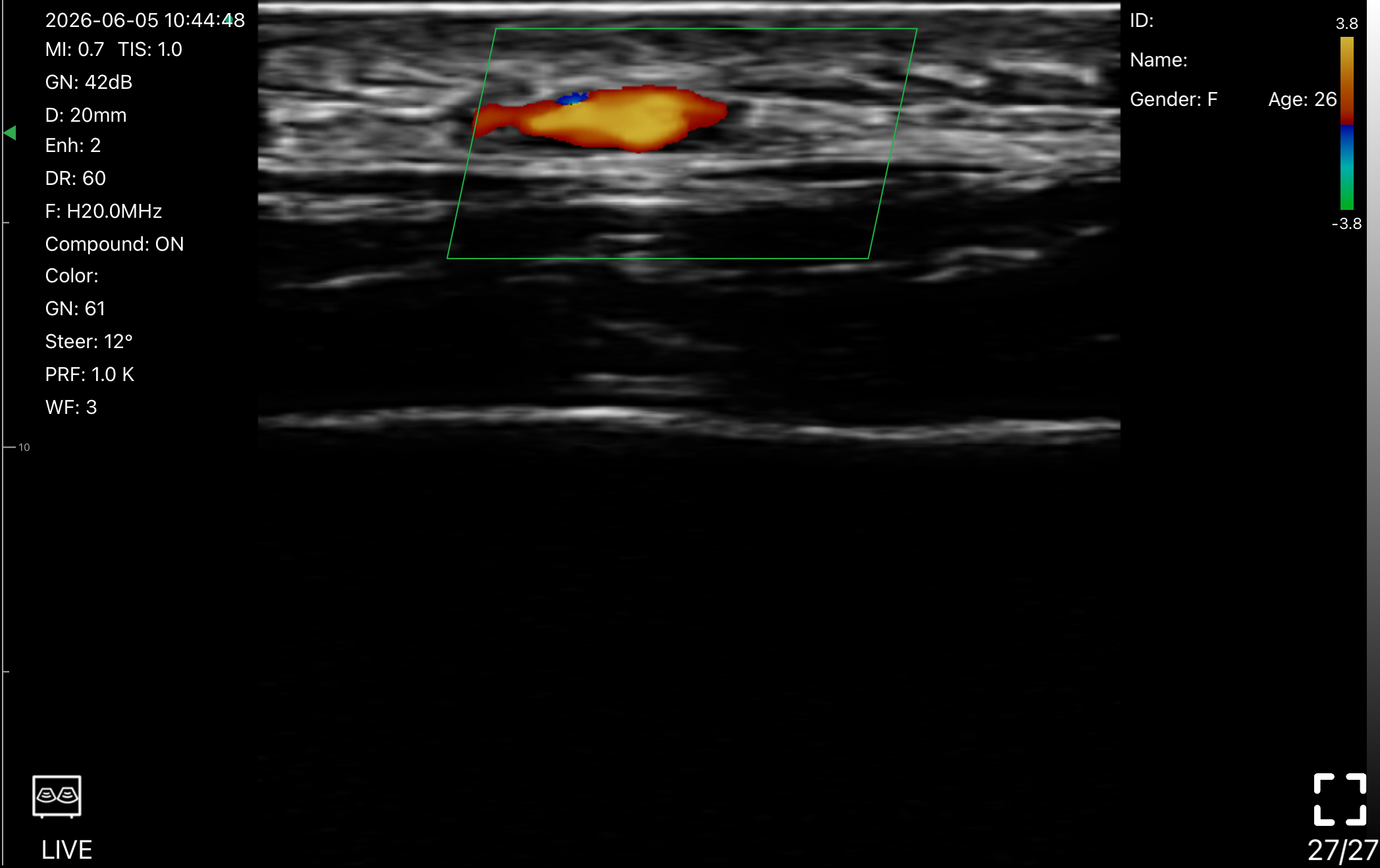 Color Doppler of subcutaneous blood flow captured on a wireless 20 MHz linear probe, June 2026