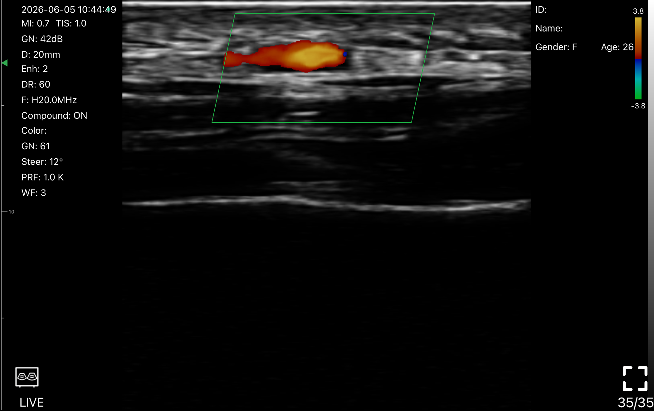 L20Pro 20 MHz color Doppler: superficial vessel, longitudinal view